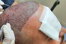 What Is ICE FUE Hair Transplant