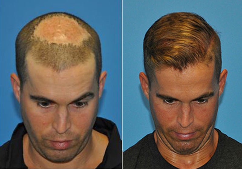 How Long Does FUE Hair Transplant Take