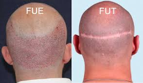 Why FUE Is Much Better Then FUT Hair Transplant
